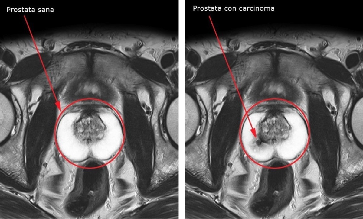 Tumore alla prostata, arriva la tecnica del laser che brucia le cellule maligne